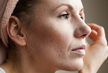 Adult Acne? I've Been There Too!