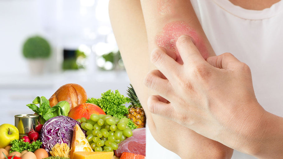 What to Eat When You Have Psoriasis