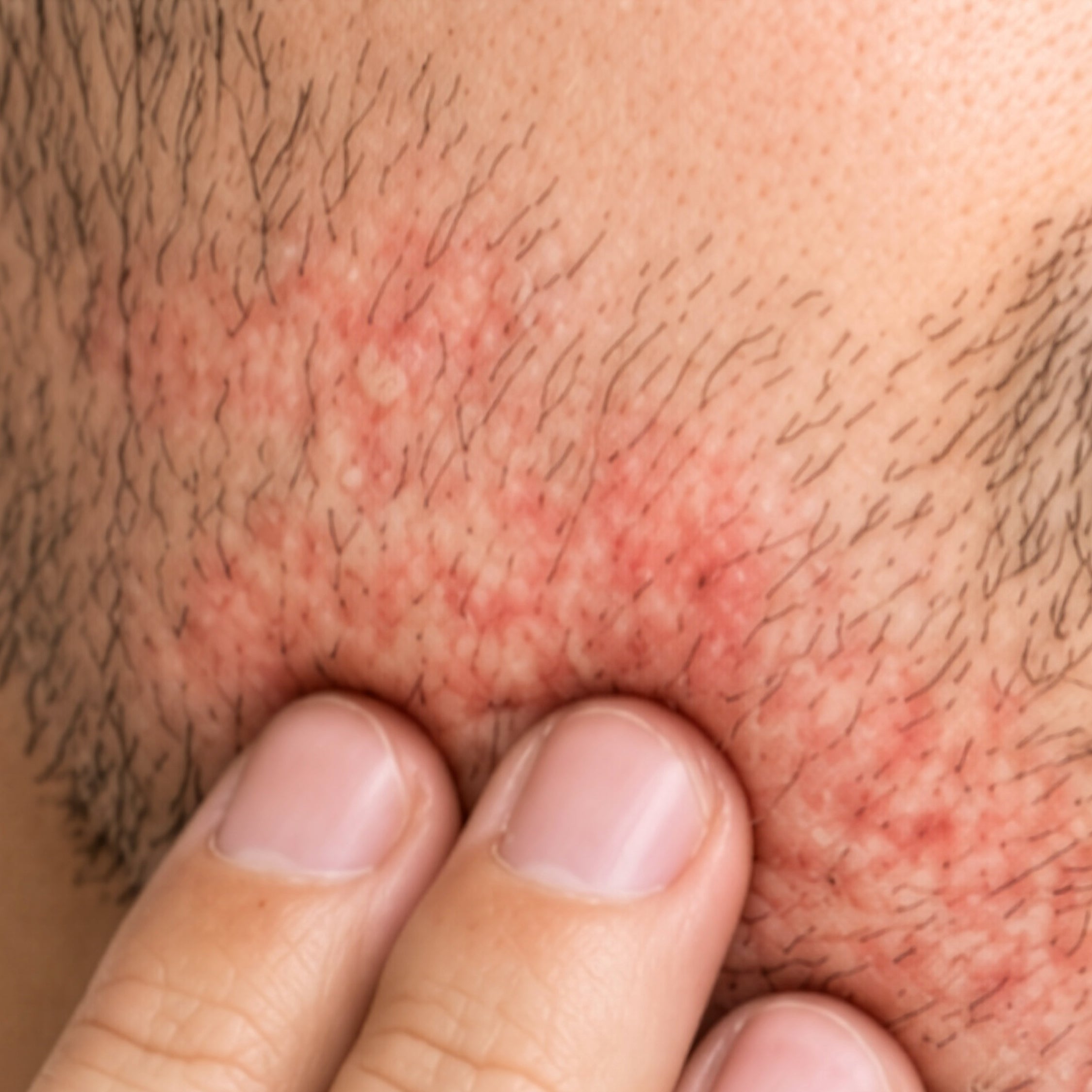 Dandruff Free Beard Wash | CONTROL
