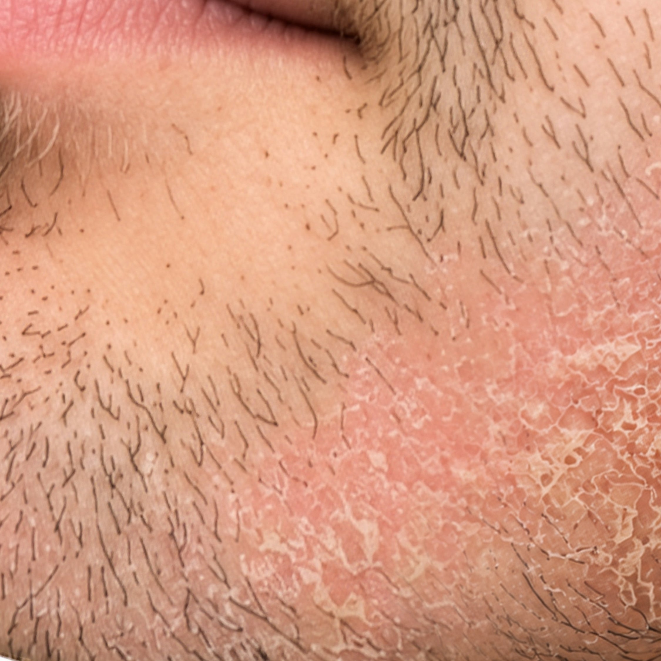 Dandruff Free Beard Wash | CONTROL