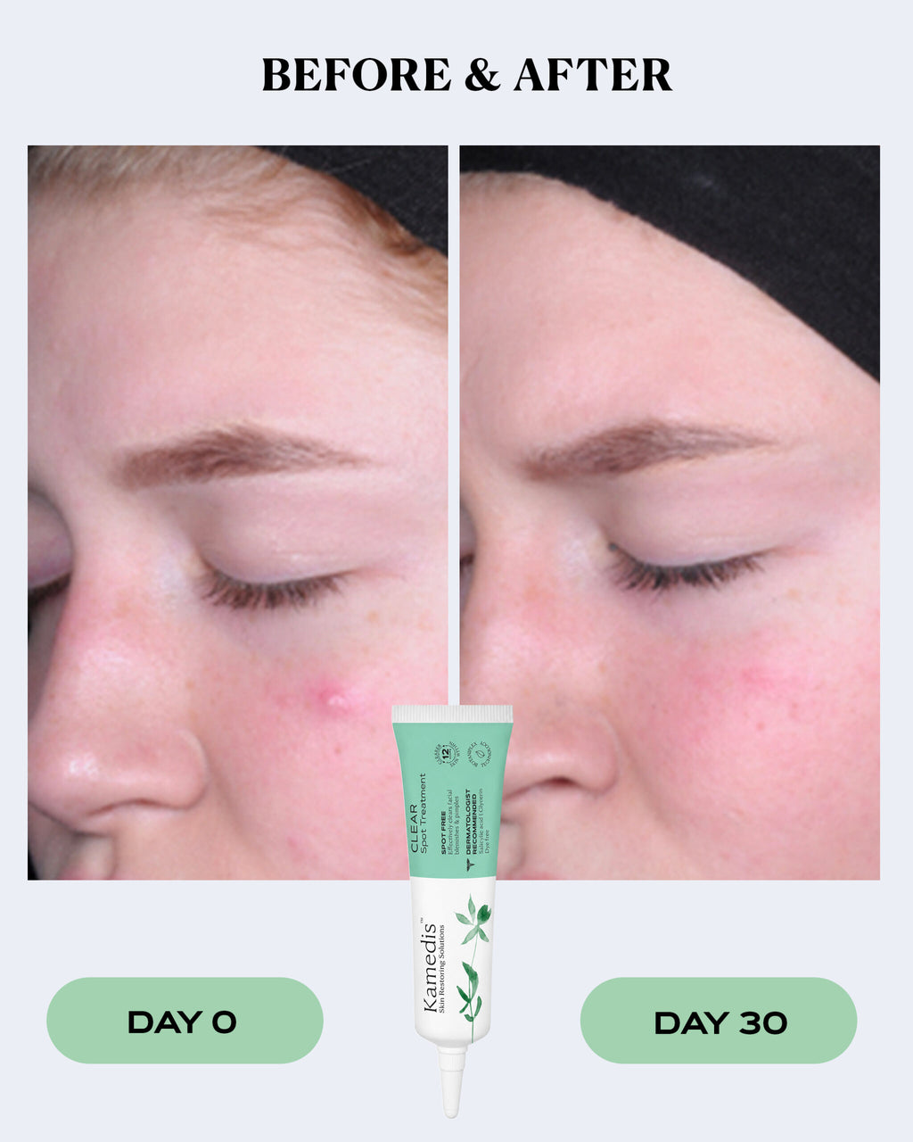 Pimple Relief Spot Treatment | CLEAR