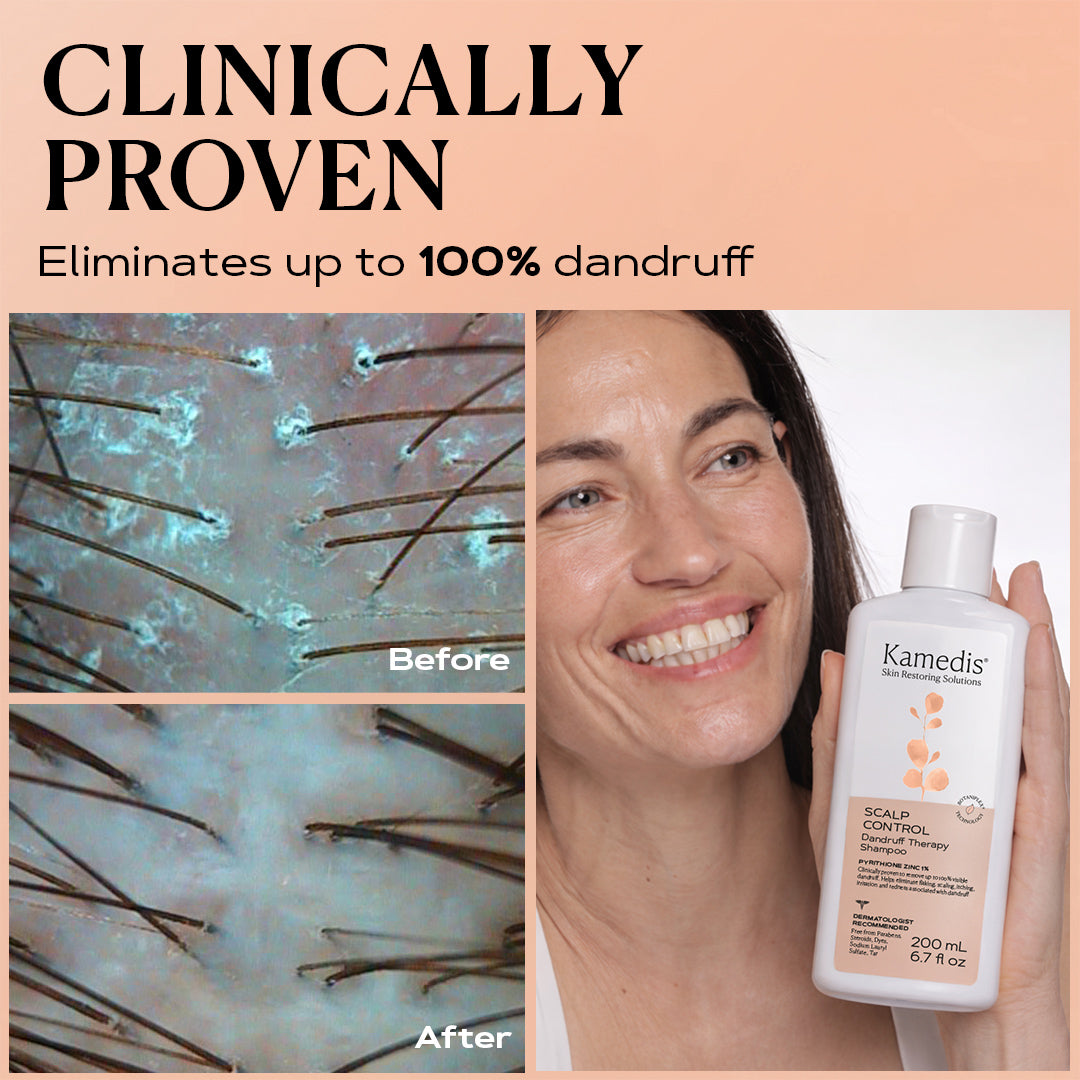 Ultimate Anti Dandruff Kit